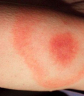Áttörés a Lyme-kór diagnosztikájában